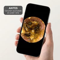 Antes: canal auditivo con cerumen acumulado que no se puede ver