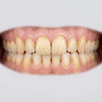 Antes: dientes amarillentos y manchados